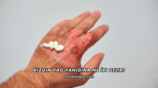 Kızgın Yağ Yanığına Ne İyi Gelir?