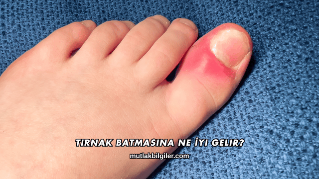 Tırnak Batmasına Ne İyi Gelir?